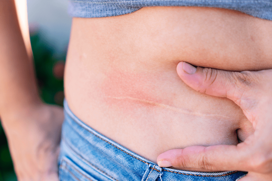 What You Need to Know About Scars Tissue After an Accident