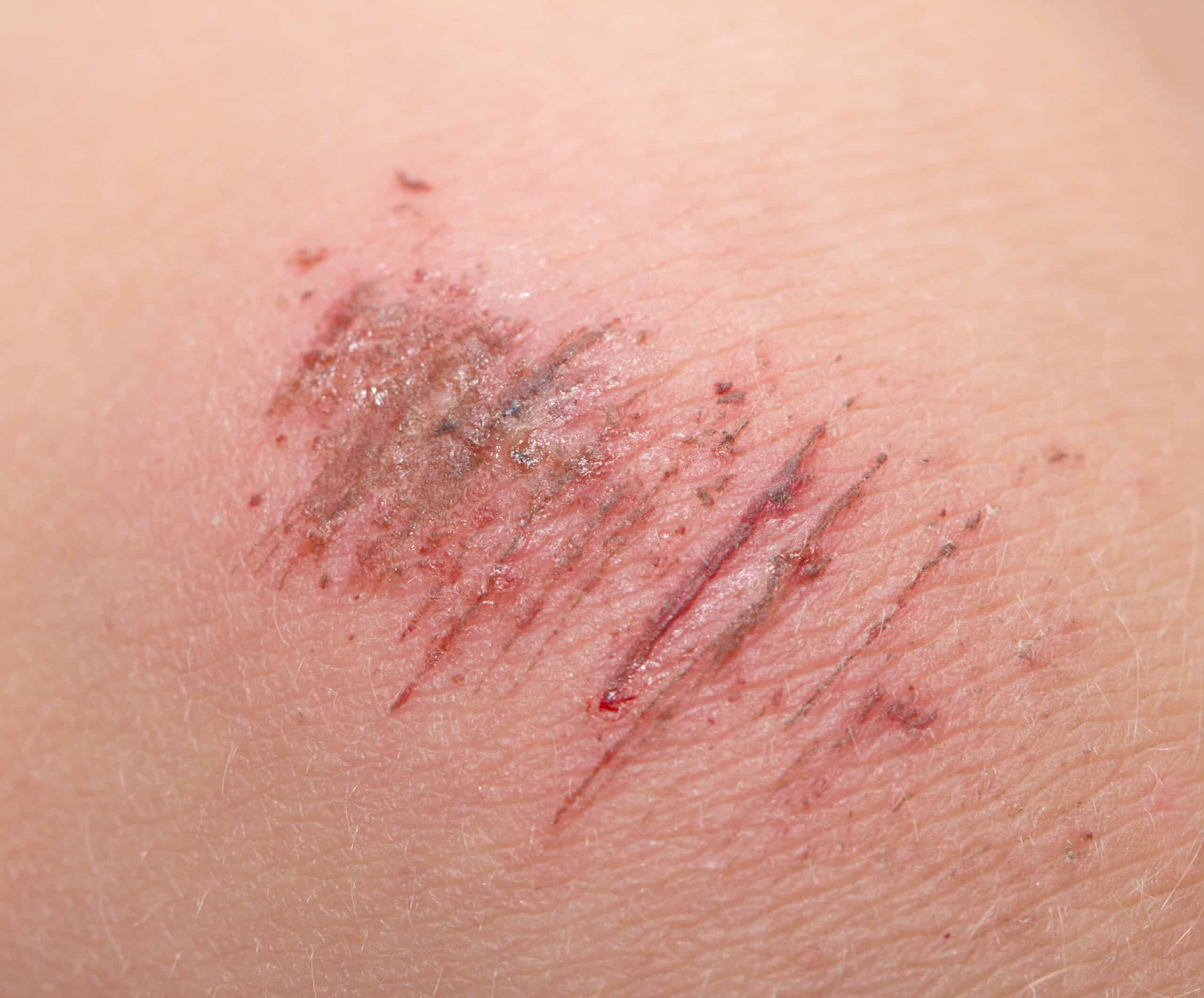 close up image of scratched skin on the knee